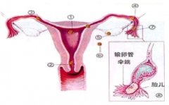 婦產(chǎn)科多種方式治愈宮外孕