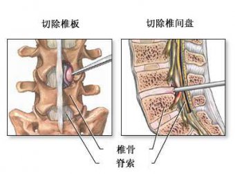 骨科特色療法——臭氧治療腰椎間盤突出