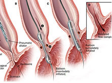 消化內(nèi)科科室特色--內(nèi)鏡下食管狹窄擴(kuò)張術(shù)