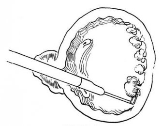 不開刀治療膀胱腫瘤——經(jīng)尿道膀胱腫瘤電切術(shù)