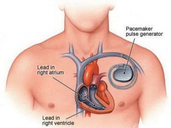 心臟起搏器植入術(shù)