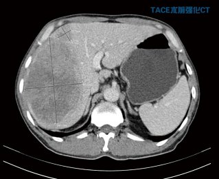 新法降服巨大肝癌