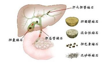 膽道切開取石術(shù)