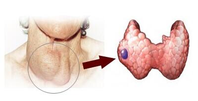 頸部小切口微創(chuàng)甲狀腺瘤切除術(shù)
