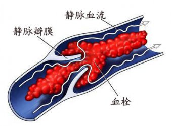 靜脈溶栓為急性腦梗死患者帶來福音