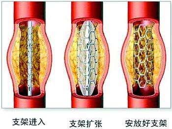 冠脈支架植入術(shù)